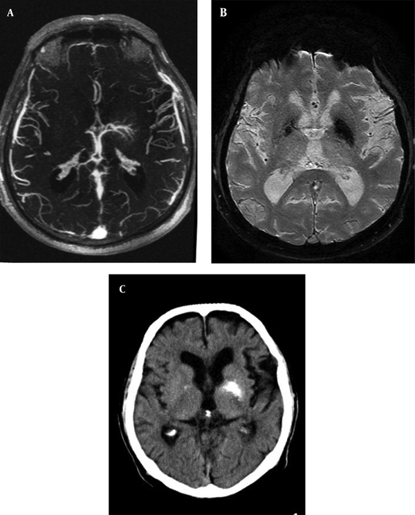 Developmental Venous Anomaly With Asymmetrical Basal Ganglia ...