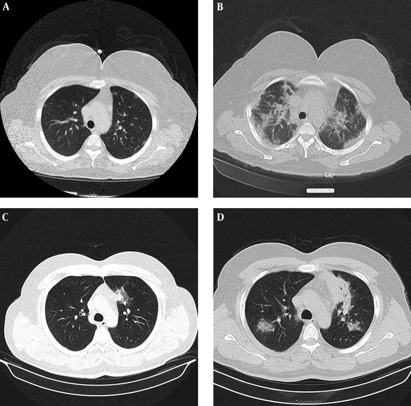 Performance of Low-Dose Chest CT Scan for Initial Triage of COVID-19 ...