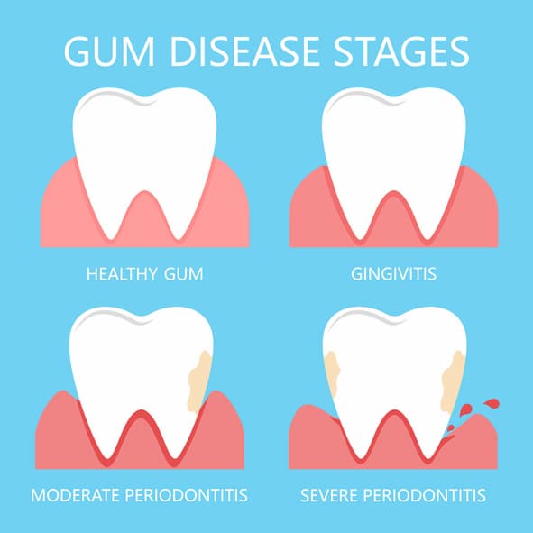 What is Gum Disease | Oral Care