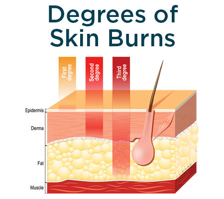 Three Main Layers Of Skin Burns