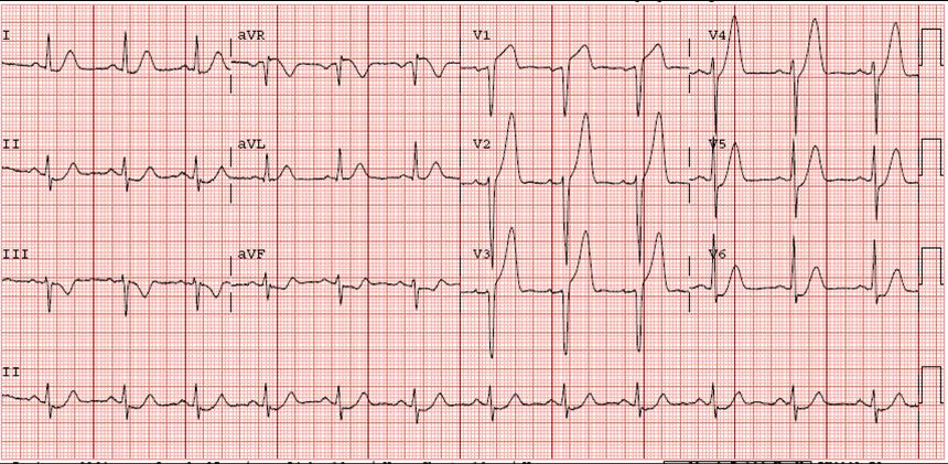 Not quite a STEMI – Sinai EM