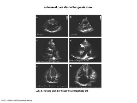 a) Normal parasternal long-axis view.