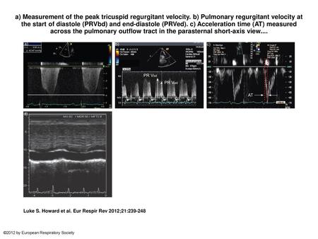 a) Measurement of the peak tricuspid regurgitant velocity