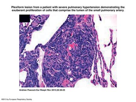 Plexiform lesion from a patient with severe pulmonary hypertension demonstrating the exuberant proliferation of cells that comprise the lumen of the small.