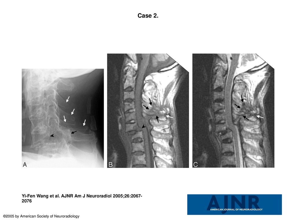 Case 2. Case 2. Fracture of the anterior C7 vertebral body and ...