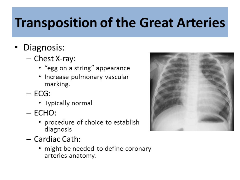 Transposition Of The Great Arteries X Ray