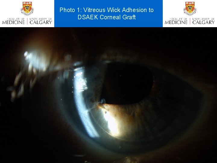 Photo 1: Vitreous Wick Adhesion to DSAEK Corneal Graft 