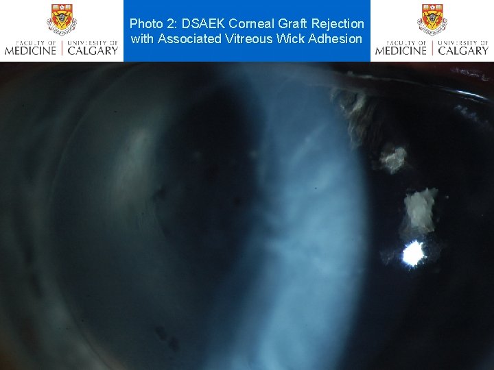 Photo 2: DSAEK Corneal Graft Rejection with Associated Vitreous Wick Adhesion 