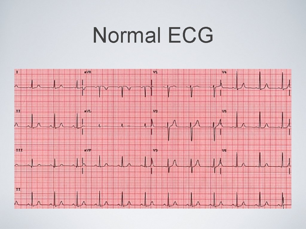 Recognizing Cardiac Arrhythmias Normal Anatomy Normal Ecg Normal | The ...