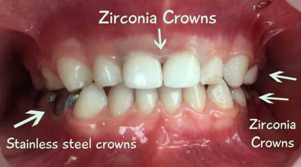 What are Zirconia Crowns?