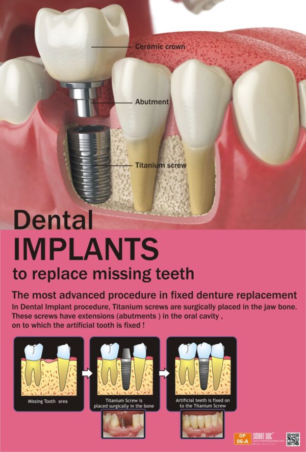 DP-06 ( A) E – Dental Implants | Smart Doc Posters