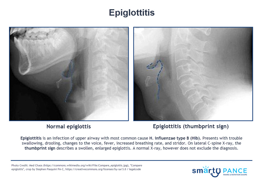 Thumb Sign Epiglottitis