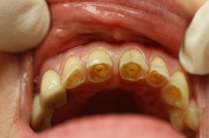 Reasons and Treatment of Enamel Erosion