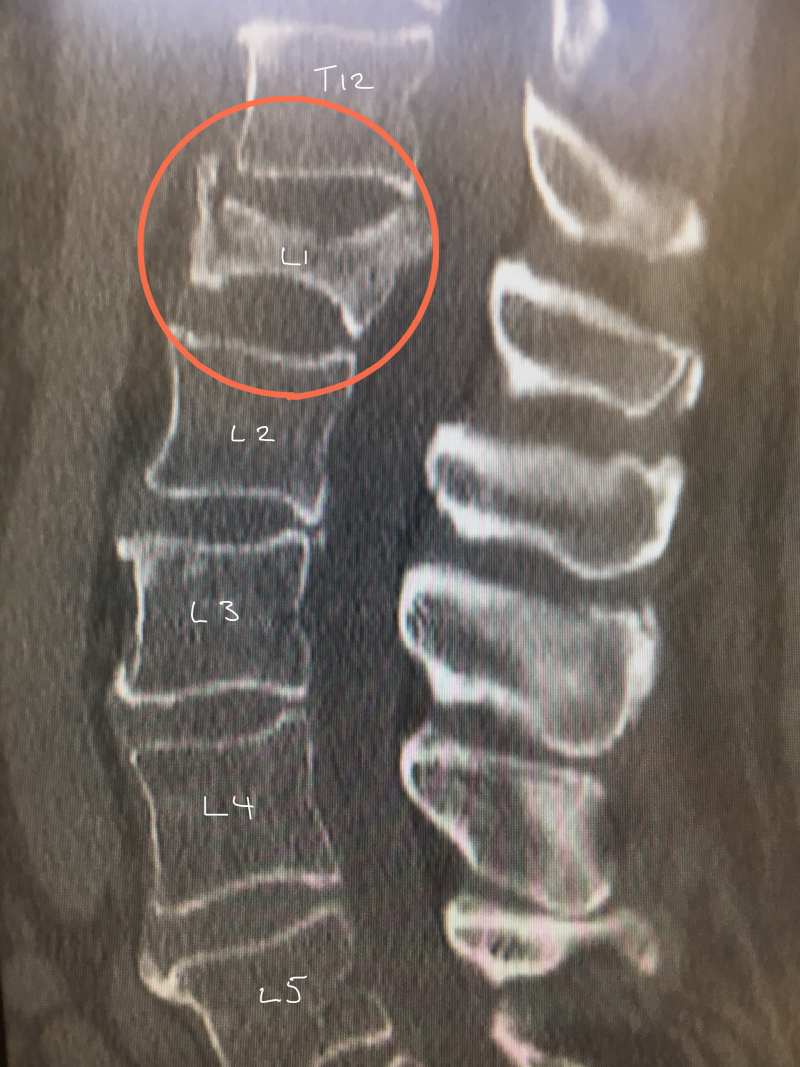 Osteoporosis And Vertebral Compression Fractures Advocacy Groups And ...