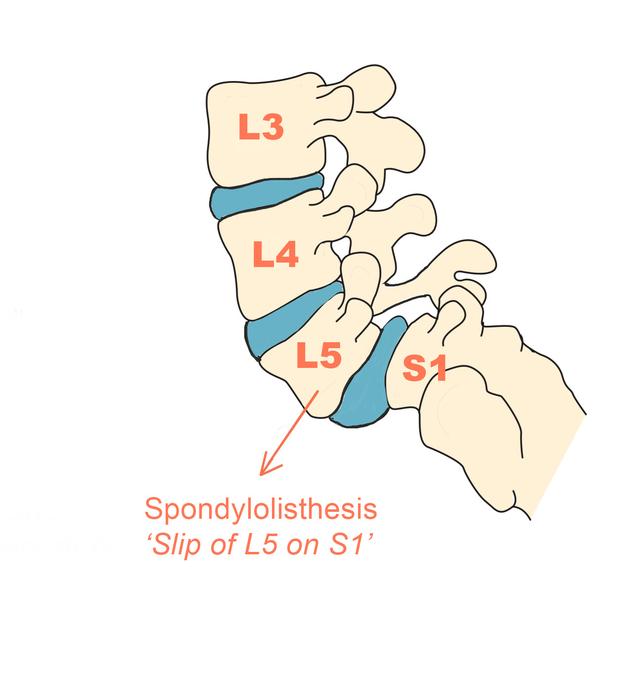 Spondylolisthesis - Spines Dorset