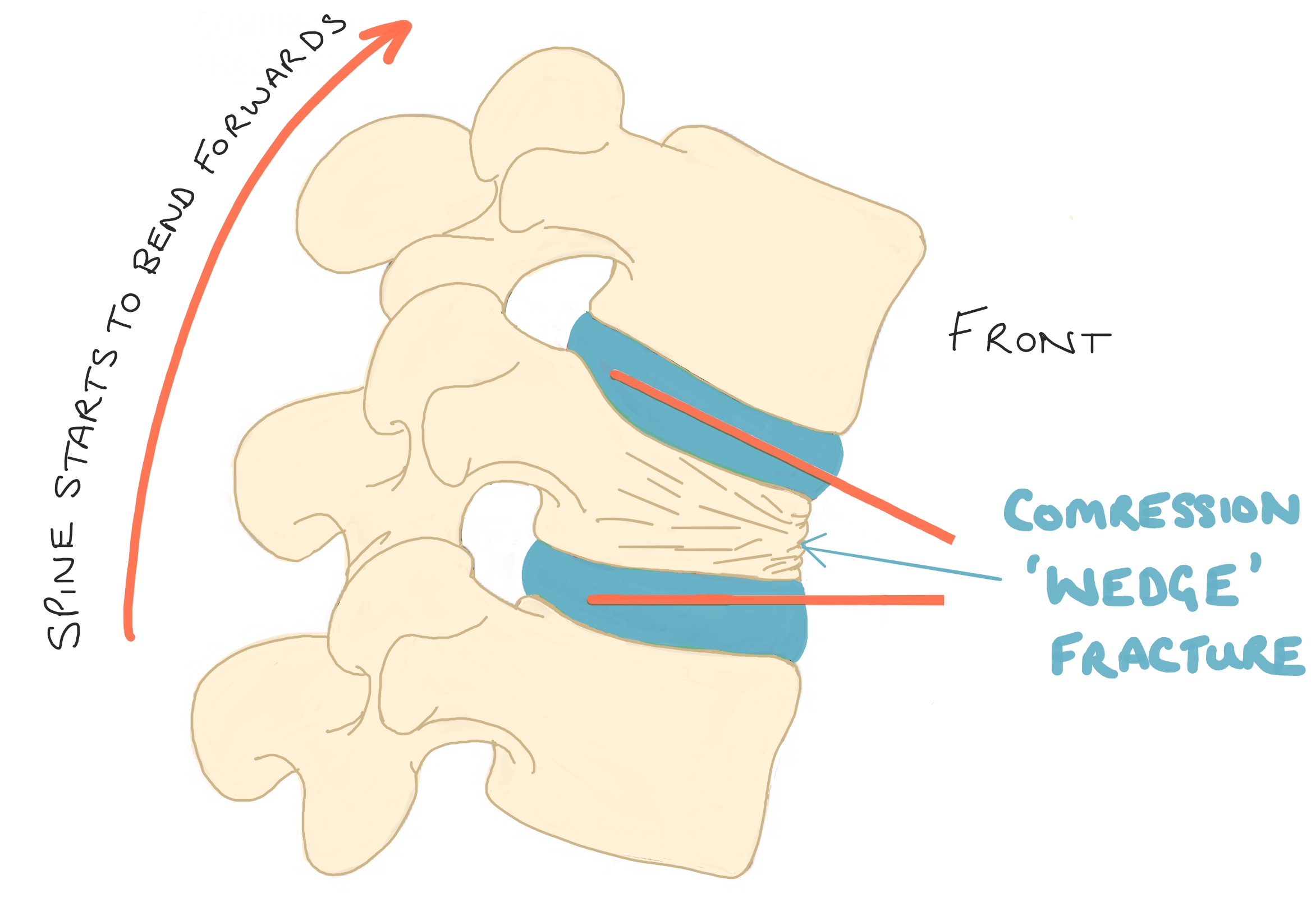 Compression Fracture Diagram