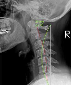 renversement-cervical-01 | SpineWorks - Chiropractic Care in Kennington ...