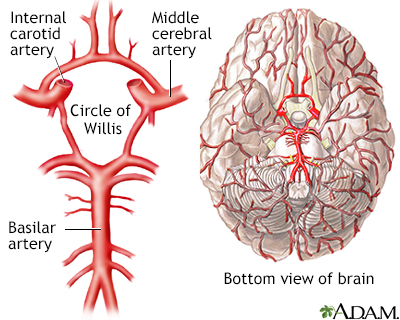 Stroke Information | Mount Sinai - New York