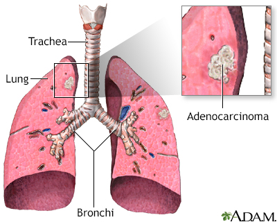 Lung Cancer Diagram For Kids