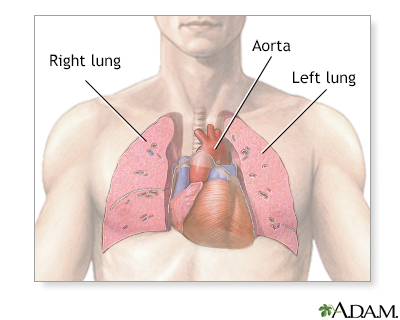 Thoracic Ct Information Mount Sinai New York