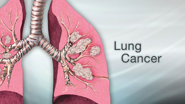 Lung Cancer Diagram For Kids