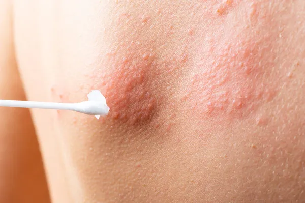 cotton swab treatment of skin rash. Shingles, varicella-zoster virus. skin rash and blisters on body. Skin infected Herpes zoster virus. Herpes Virus on body. urticaria rash. atopic dermatitis.