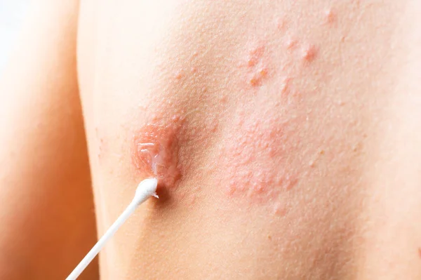 cotton swab treatment of skin rash. Shingles, varicella-zoster virus. skin rash and blisters on body. Skin infected Herpes zoster virus. Herpes Virus on body. urticaria rash. atopic dermatitis.