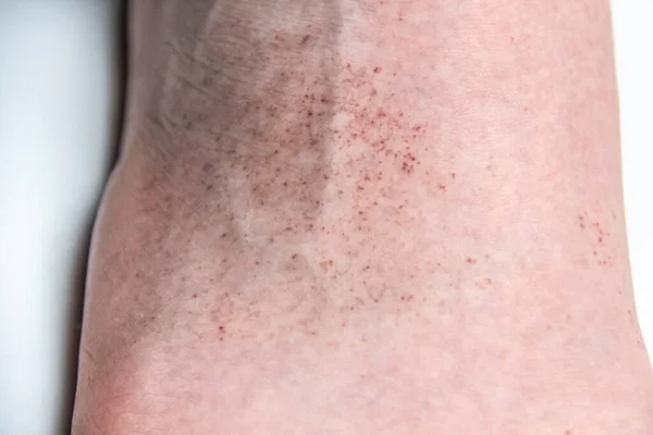 A red rash on the foot of a male against background. CloseUp a part of the leg with red allergic rash. Skin with allergy