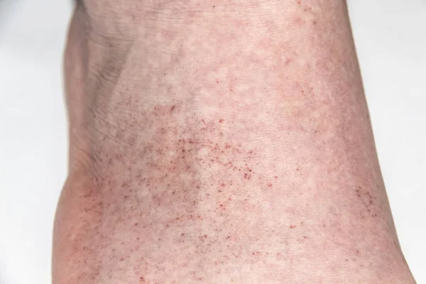 A red rash on the foot of a male against background. CloseUp a part of the leg with red allergic rash. Skin with allergy