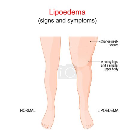 Illustration for Lipoedema or Lipedema. abnormal build-up of fat in legs. difference and comparison normal healthy leg and affected leg with skin an "orange peel" texture. vector illustration - Royalty Free Image