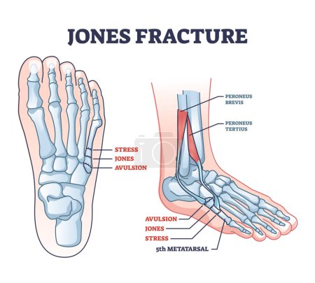 Illustration for Jones fracture and foot pinky finger bone broken damage outline diagram. Labeled educational scheme with bone stress or avulsion sections vetor illustration. Peroneus brevis and tertius muscle anatomy - Royalty Free Image