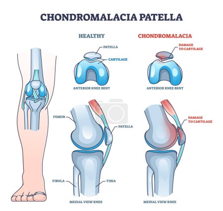 Illustration for Chondromalacia patella knee breakdown compared with healthy outline diagram. Labeled educational kneecap tissue damage with cartilage problem and anatomical leg joint structure vector illustration. - Royalty Free Image