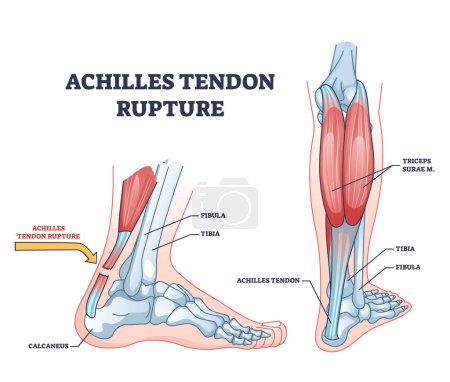 Illustration for Achilles tendon rupture as painful injury and leg trauma outline diagram. Labeled educational anatomical scheme with orthopedic problem explanation vector illustration. Medical body muscle condition. - Royalty Free Image