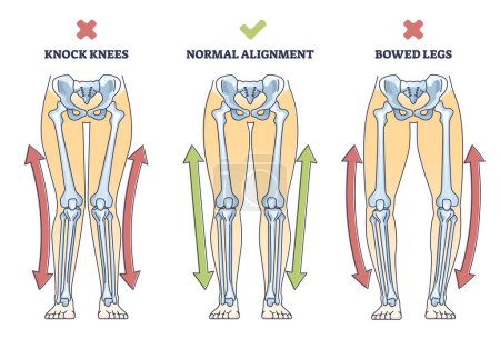 Illustration for Bowed legs syndrome with normal and knock legs comparison outline diagram. Labeled educational physical defect with outward bending and knees does not touch vector illustration. Anatomical explanation - Royalty Free Image