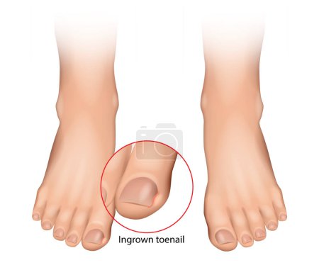 Illustration for Ingrown toenail or onychocryptosis that occurs when the nail edge grows into the periungual dermis. Nail disease. - Royalty Free Image