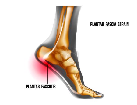 Illustration for Plantar fasciitis inflammation and ruptures strain. Bones ot Foot pain realistic illustration. Medial view. Anatomy of joints, human leg black and yellow transparente skeleton. For medical orthopedic - Royalty Free Image