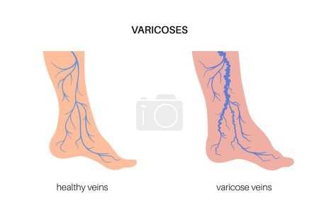 Illustration for Edema and varicose veins. Swelling and pain in human legs. Vascular disease diagnostic and treatment. Abnormal blood pressure, weak vein and valves. Venous insufficiency medical vector illustration - Royalty Free Image