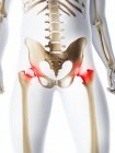 Focus of inflammation localized in hip joint — Stock Photo