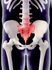 Focus of inflammation localized in sacrum — Stock Photo