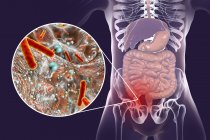 Illustration of red and inflamed human appendix and close-up of bacteria causative agents of appendicitis. — Stock Photo