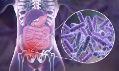 Illustration of red and inflamed human appendix and close-up of bacteria causative agents of appendicitis. — Stock Photo