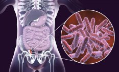 Illustration of red and inflamed human appendix and close-up of bacteria causative agents of appendicitis. — Stock Photo