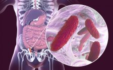 Illustration of red and inflamed human appendix and close-up of bacteria causative agents of appendicitis. — Stock Photo