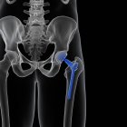 Illustration of medical hip replacement on black background. — Stock Photo