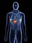 Illustration of adrenal glands cancer in male body silhouette. — Stock Photo