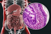 Colon cancer, digital illustration and light micrograph showing colon adenocarcinoma. — Stock Photo