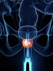 Inflamed prostate in abstract male body, digital illustration. — Stock Photo