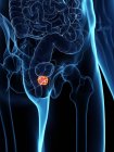 Inflamed prostate in abstract male body, digital illustration. — Stock Photo