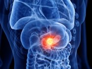 Pancreas cancer in male body, computer illustration. — Stock Photo