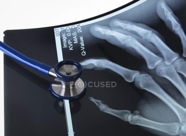 X-ray image of hand bones — Stock Photo